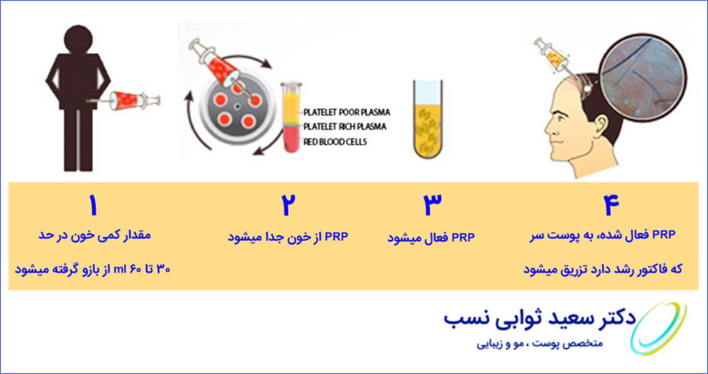 PRP روش ترمیم مو با استفاده از سلول بنیادی - وب سایت دکتر ثوابی نسب