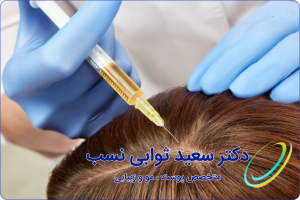 prp ترمیم مو به روش استفاده از سلول های بنیادی - وبسایت دکتر ثوابی نسب