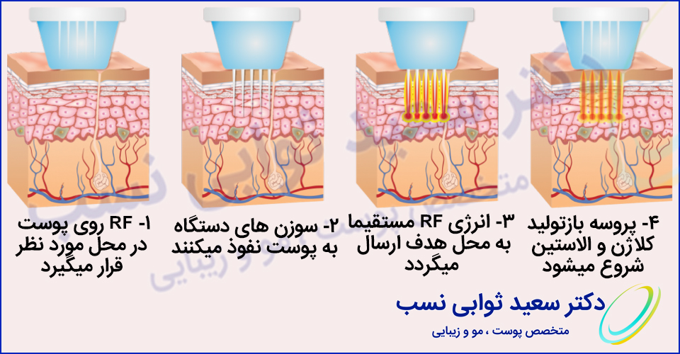 جوانسازی-لیفتینگ-صورت با دستگاه RF - وبسایت دکتر ثوابی نسب